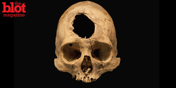 For centuries, people have taken to trepanation, a procedure in which a hole is drilled into the skull. Some say it relieves pain, some get a euphoric high. (© Scientifica, I/Visuals Unlimited/Corbis photo)