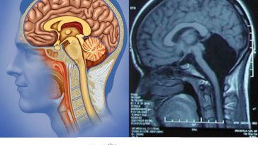 Chinese Woman Suffers Dizziness, But Was Just Missing Her Cerebellum
